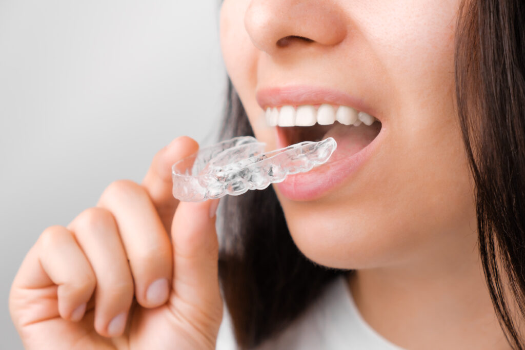Aligneurs-orthodontie